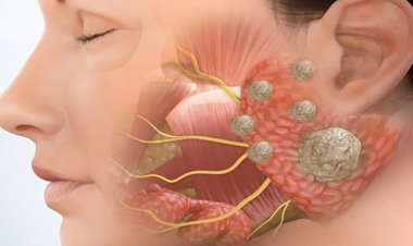 أعراض غير متوقعة تكشف أورام الغدد اللعابية