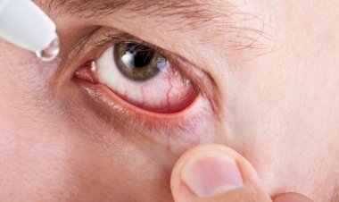 منظمة الصحة العالمية تعلن خلو مصر من «التراكوما»