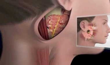 تشبه الانفلونزا .. اكتشف أعراض غدة النكاف