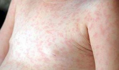 الحمى الوردية عند الأطفال.. الأعراض وطرق العلاج