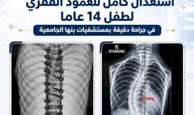 التعليم العالي:  استعدال كامل للعمود الفقري لطفل 14 عامًا بمستشفيات جامعة بنها