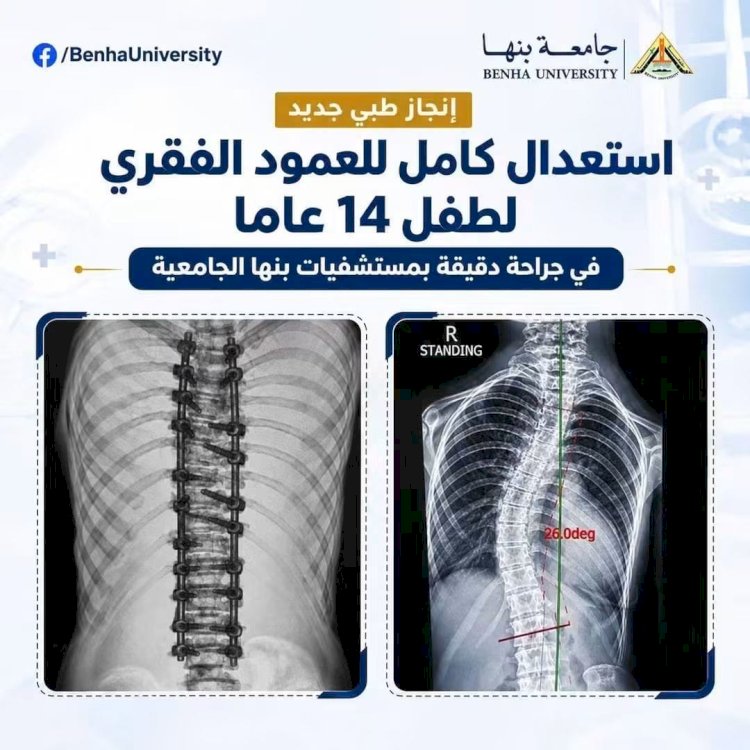 التعليم العالي:  استعدال كامل للعمود الفقري لطفل 14 عامًا بمستشفيات جامعة بنها
